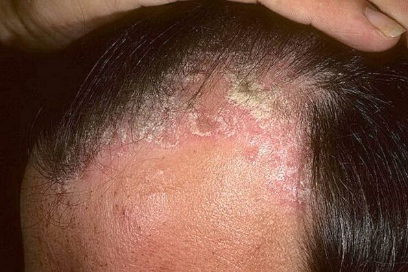 Psoriasis -Symptome