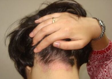 Psoriasis im Kopf