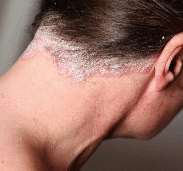 Wie man Psoriasis behandelt