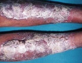 Psoriasis -Salbe