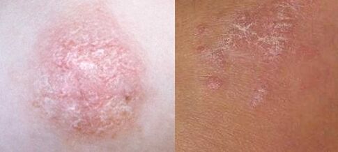 Psoriasis im Anfangsstadium